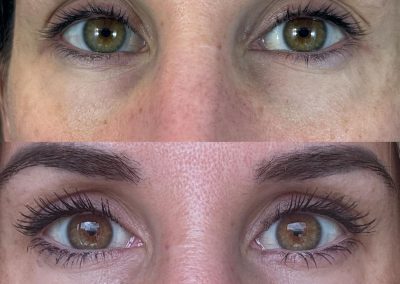 alquiler láser Q-Switched