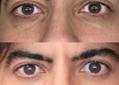 compra de equipos láser estéticos